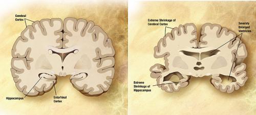 1-alzheimersdi