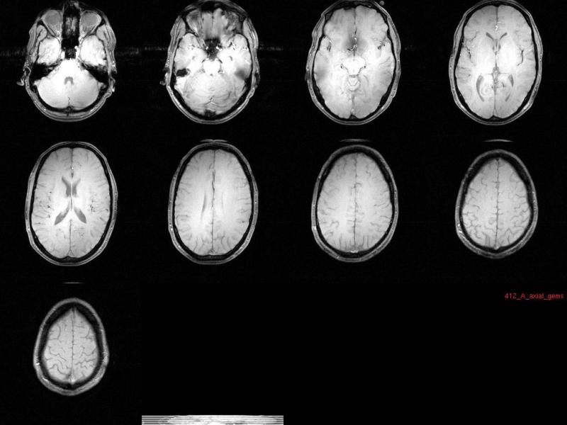 Autism Starts Months Before Symptoms >> Autism Starts Months Before Symptoms Appear Generation Next Autism Starts Months Before Symptoms >> Autism Starts Months Before Symptoms Appear Generation Next